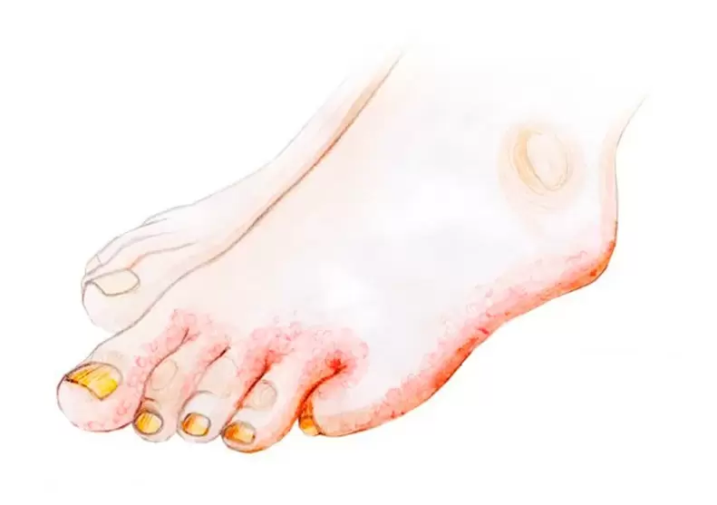 Fungus on the toes and how to apply the cream Zenidol