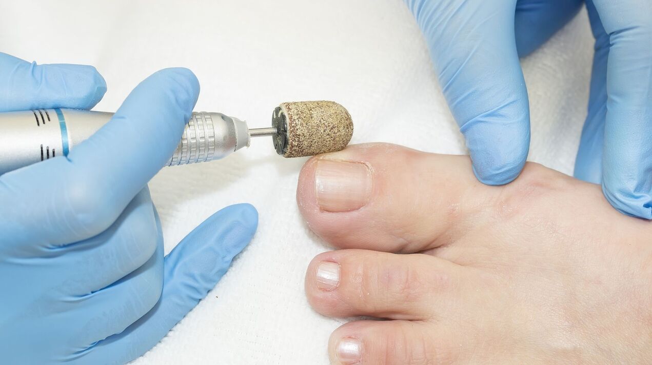 toenail fungus hardware treatment