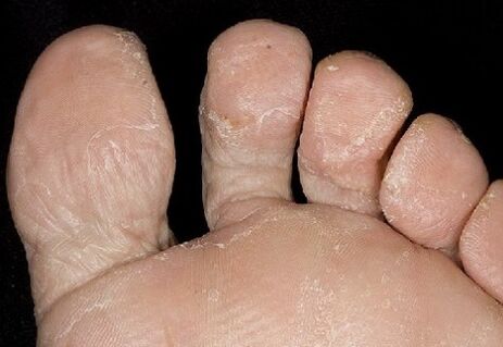 The early stage of the fungus, between the fingers