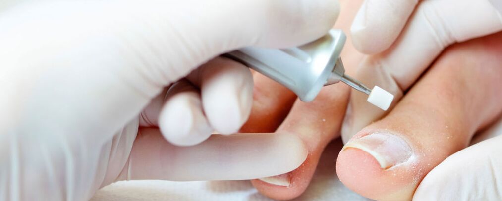 Cutting the upper layer of the nail
