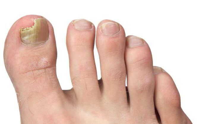 Fungus on the foot thumb
