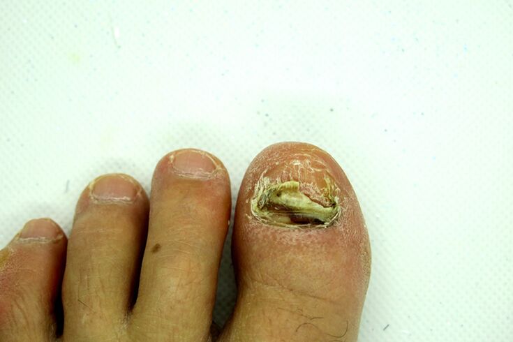 Finge Fungus - Heavy Stage