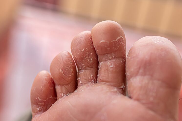 Finge Skin Fungus - Early Stage