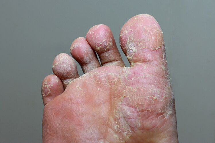 Severe stage of fingertips