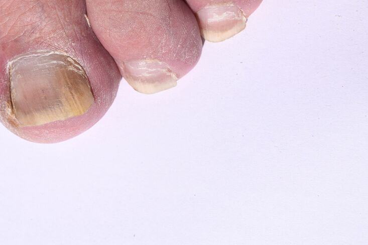 The early stage of nail ringworm on the legs