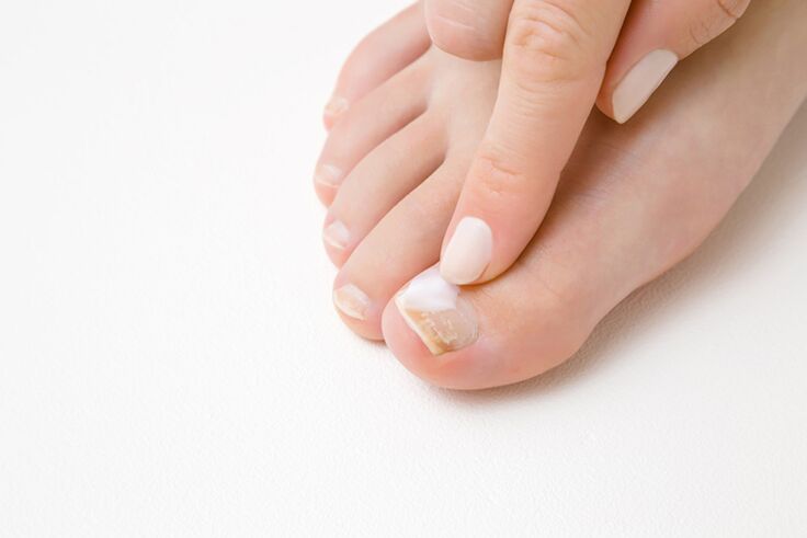 Treatment of fingers with fungus ointment