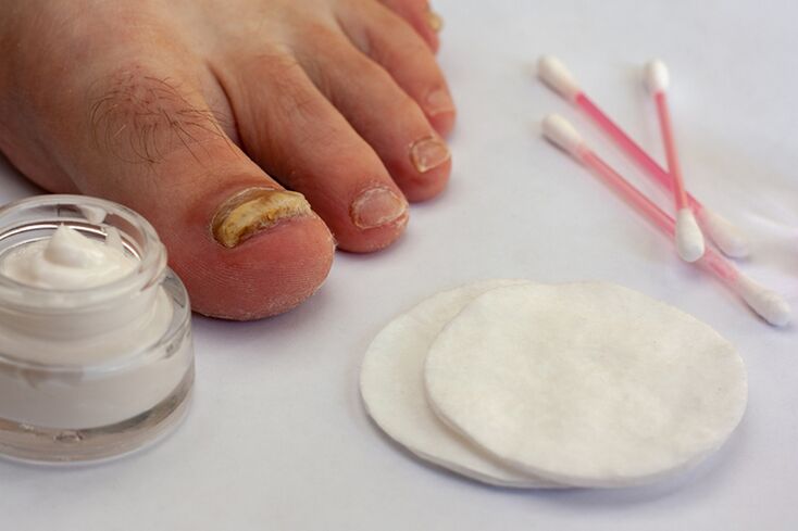 Treatment of fungal fingers with fungus cream