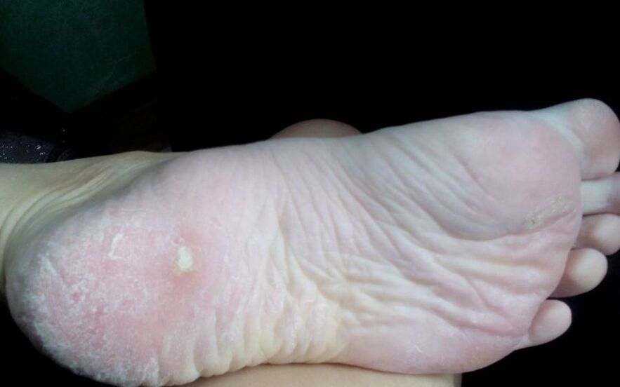 How the fungus looks and manifests