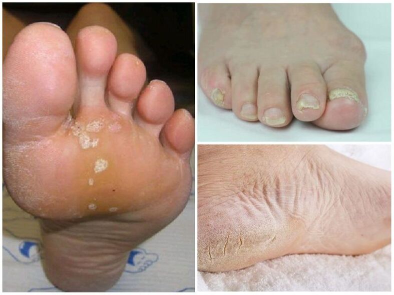 Mycoses symptoms