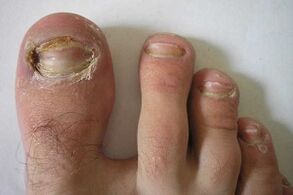damage to the nail plates of the toes due to a fungal infection