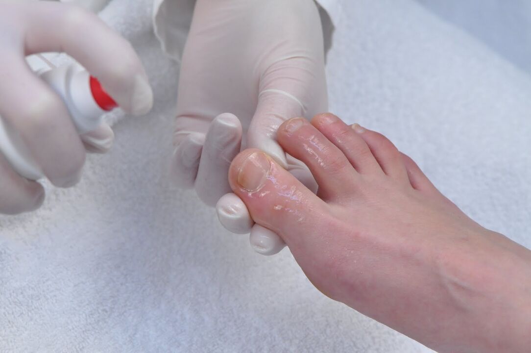 nail treatment for fungus