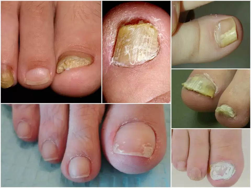Appearance of different forms of onychomycosis
