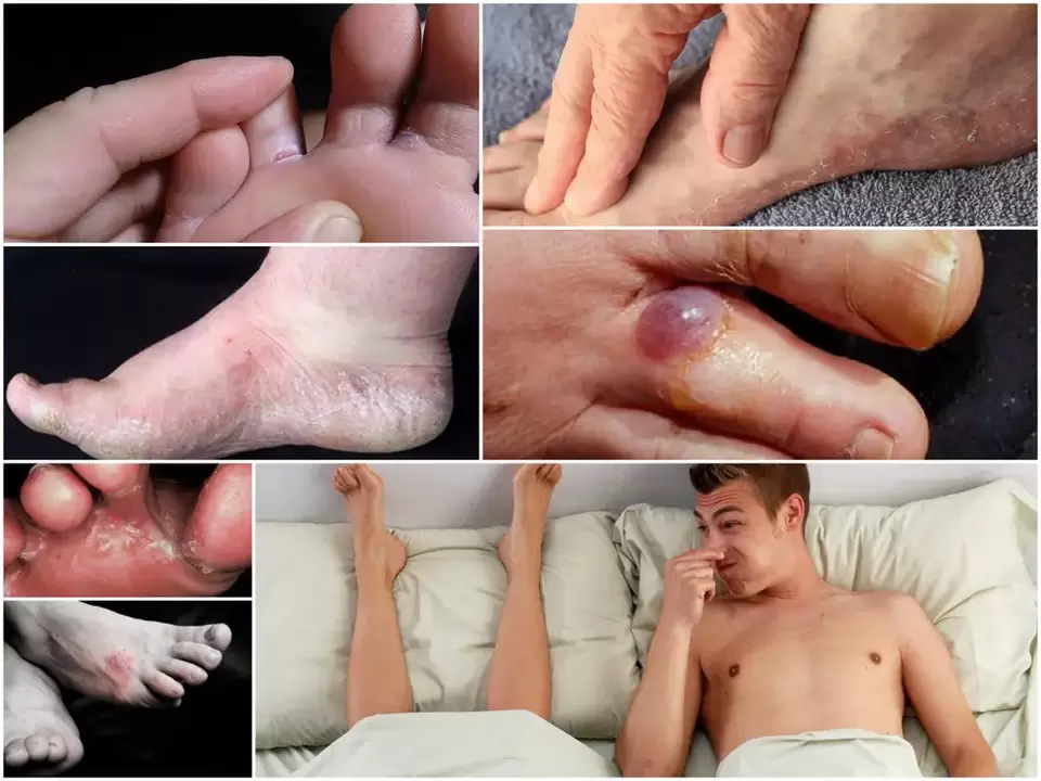 Main signs of foot fungus