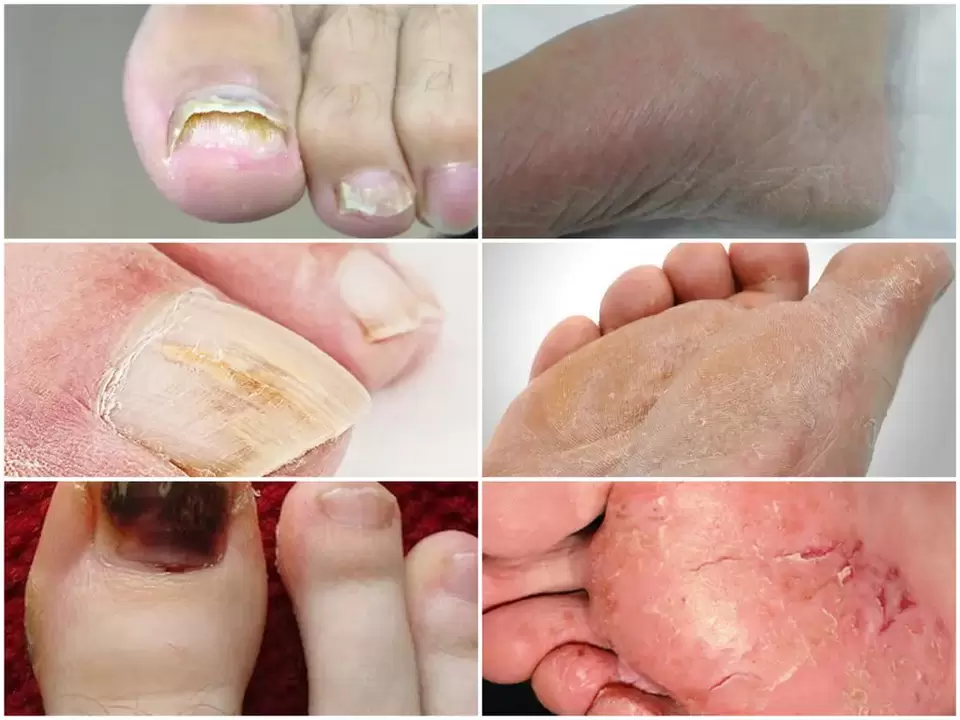Manifestations of foot fungus from various pathogens