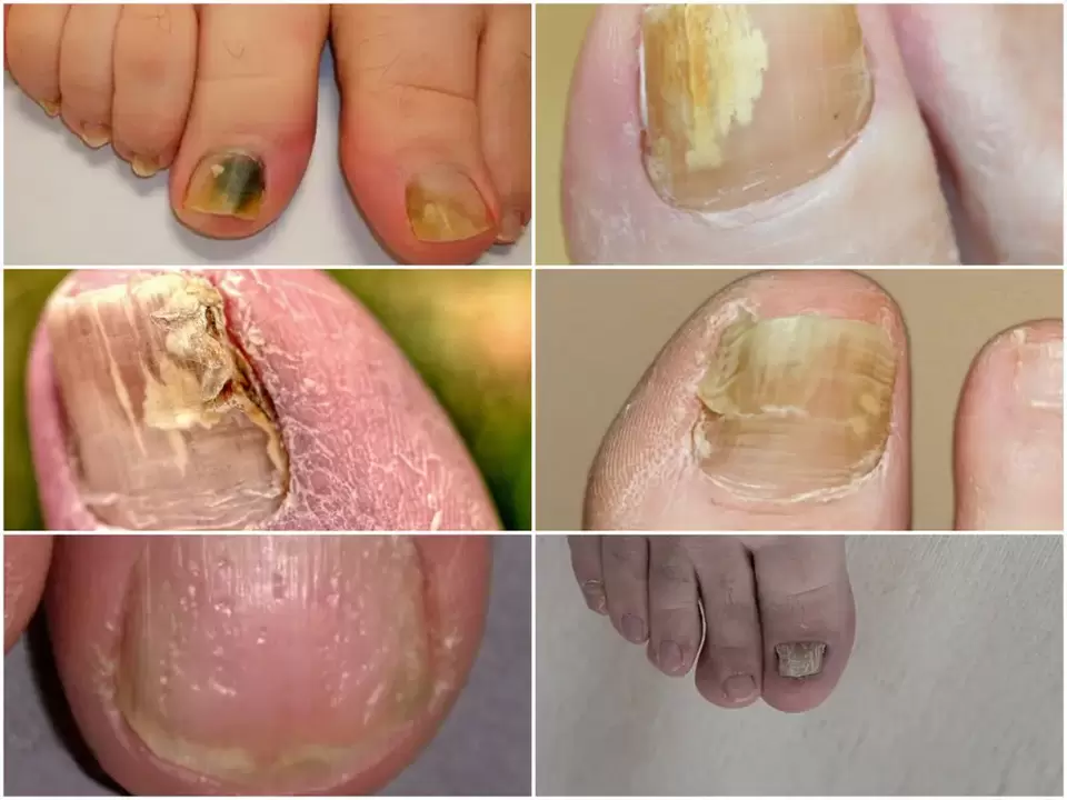 Symptoms of onychomycosis - changes in nail color and structure