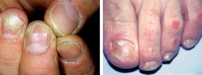 manifestations of fungal nail infection