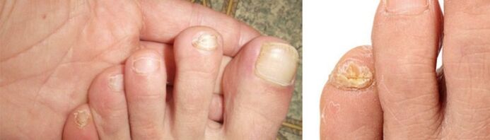 photo of toenail fungus manifestations