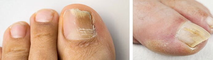 photo of a fungal infection on the big toe nail