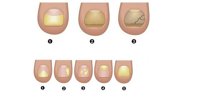 toenail fungus stages and symptoms