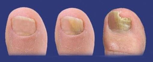 stages of development of the fungus in the toenails