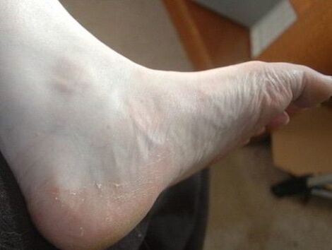 desquamation of the foot of the leg as a sign of fungal infection