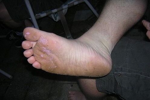 fungus foot