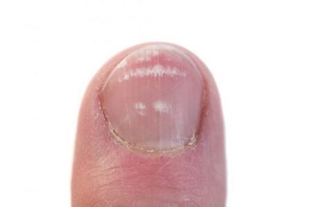 the early stage of nail fungus infection